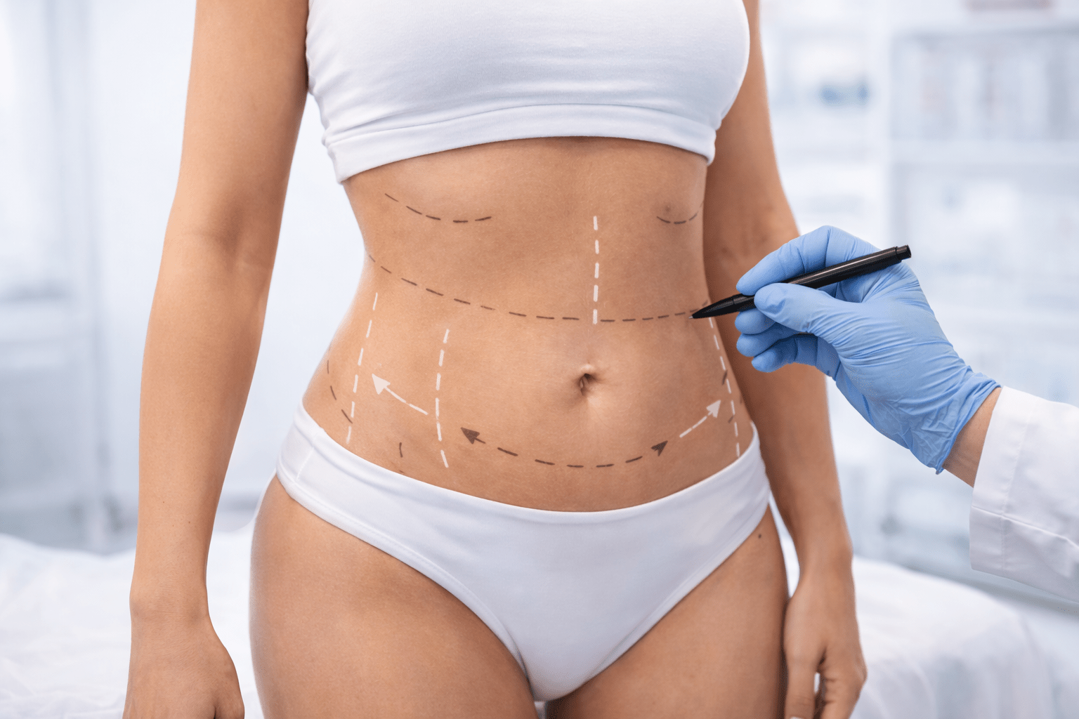 Plastic surgeon marking abdominal area on female patient during tummy tuck consultation in aesthetic clinic