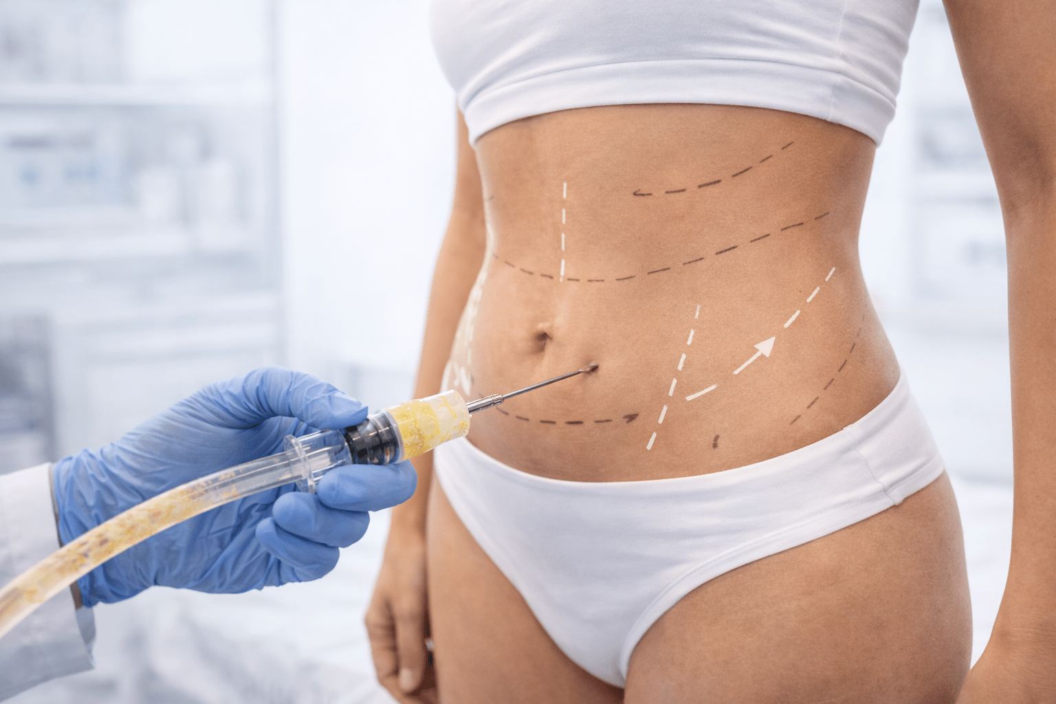 Plastic surgeon preparing liposuction treatment on female abdomen with surgical markings during cosmetic surgery consultation