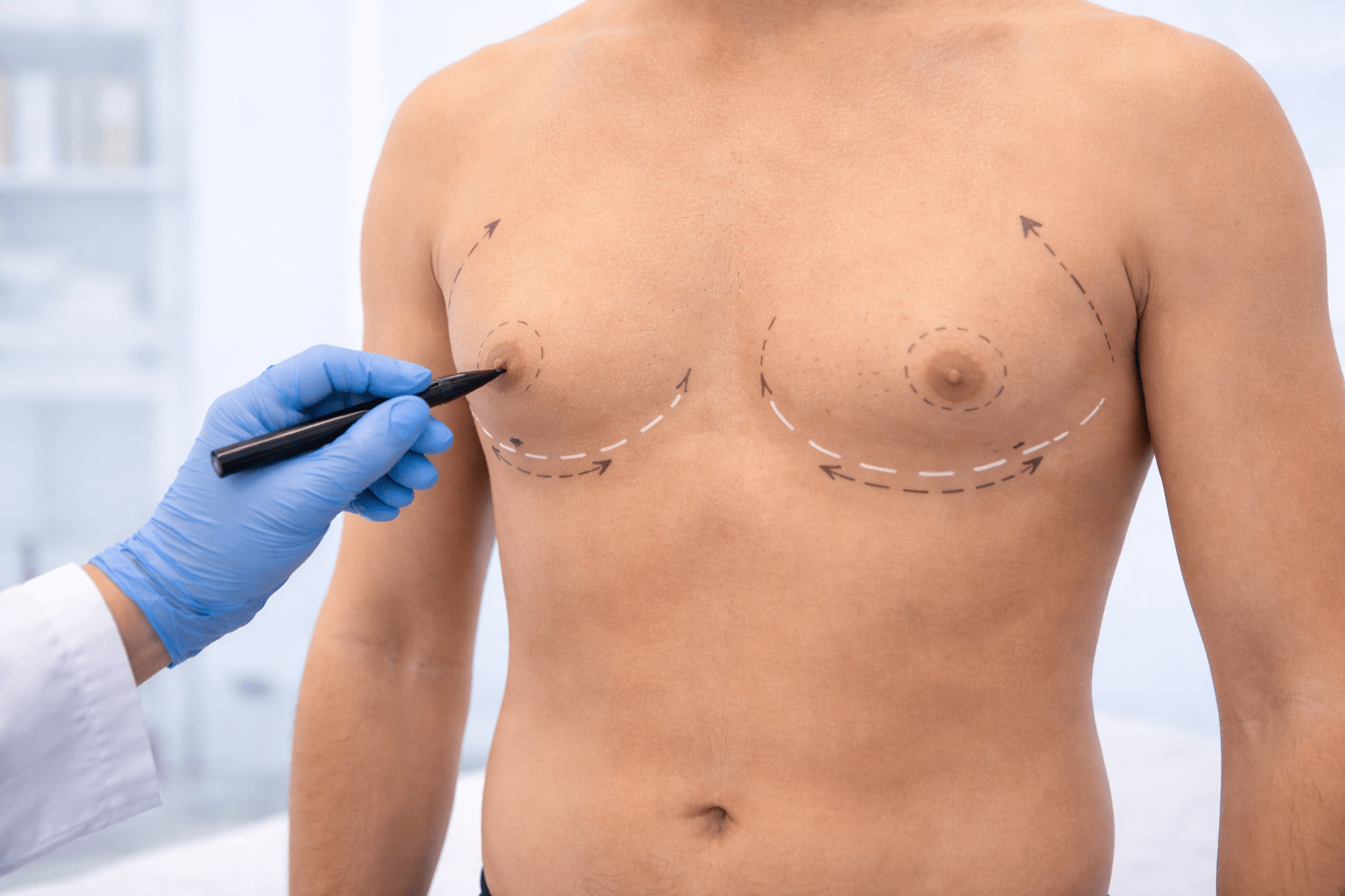 Plastic surgeon marking male chest area during gynecomastia surgery consultation in aesthetic clinic