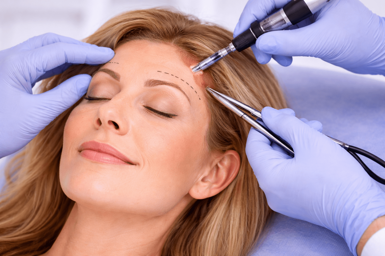 Hair restoration procedure in progress