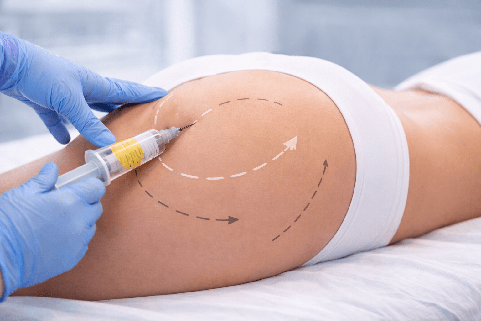 Plastic surgeon performing Brazilian butt lift fat transfer injection on female buttocks with surgical planning markings in aesthetic clinic